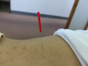 痛くないように鍼をする　置鍼