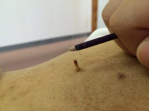 熱くない灸