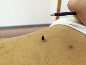 熱くない灸