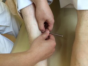 刺さない鍼